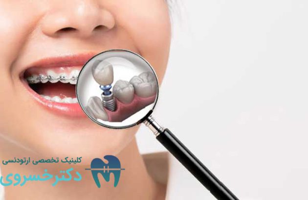 ارتودنسی دندان‌ های ایمپلنت