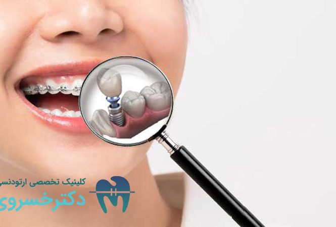ارتودنسی دندان‌ های ایمپلنت