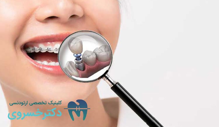 ارتودنسی دندان های ایمپلنت