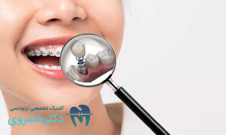 ارتودنسی دندان‌ های ایمپلنت