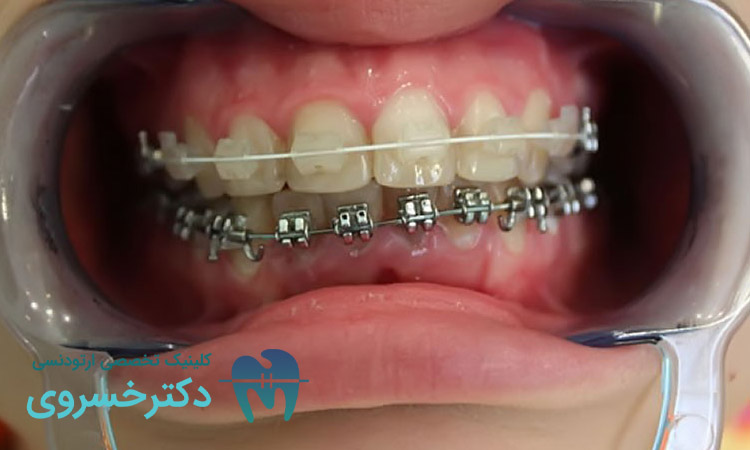 اصول پایهای ارتودنسی در درمان اوپن بایت