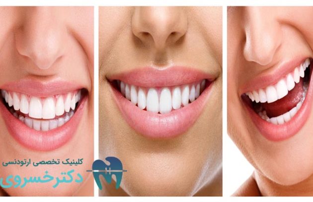 انواع بایت دندان