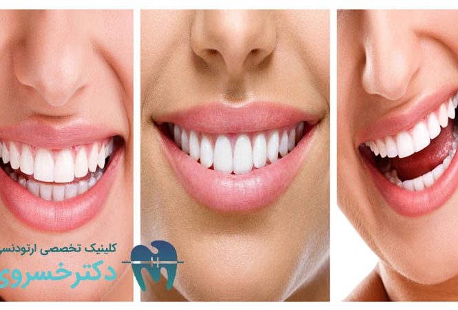 انواع بایت دندان