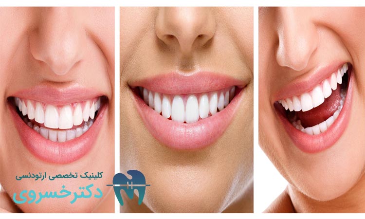 انواع بایت دندان