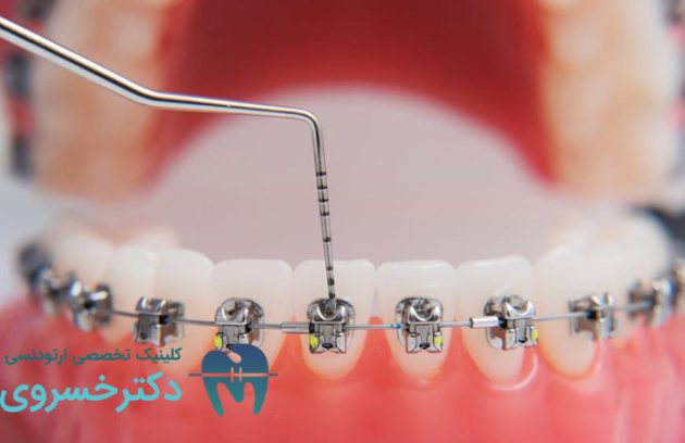 تحلیل لثه در ارتودنسی