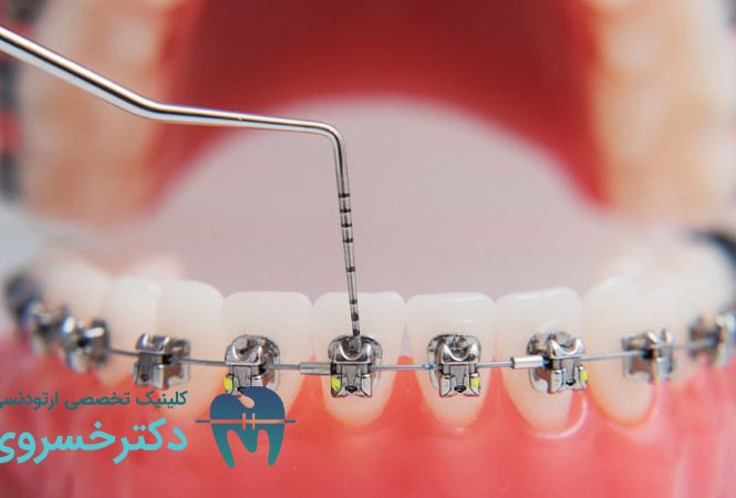 تحلیل لثه در ارتودنسی
