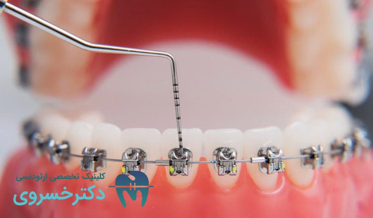 تحلیل لثه در ارتودنسی