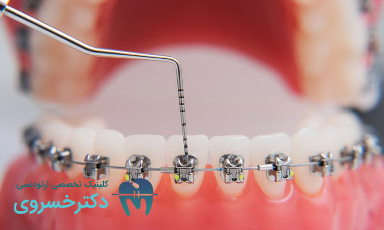 تحلیل لثه در ارتودنسی