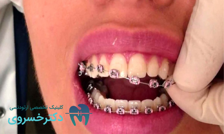 تفاوتهای فردی در تجربه درد ارتودنسی