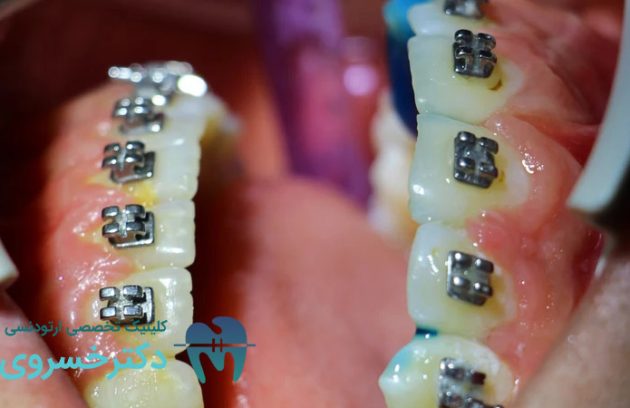 درمان اوپن بایت با ارتودنسی