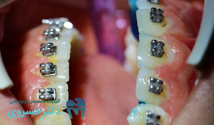 درمان اوپن بایت با ارتودنسی