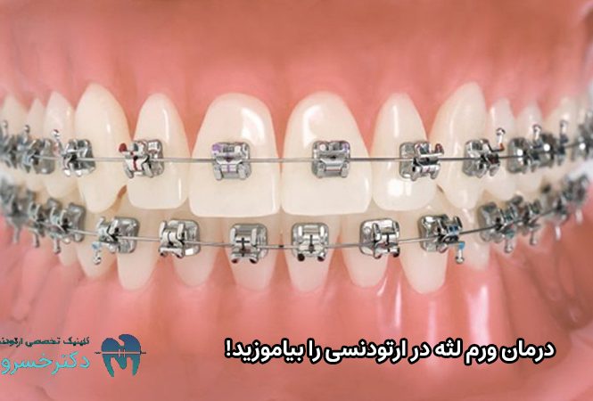 درمان ورم لثه در ارتودنسی