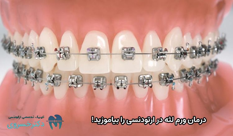 درمان ورم لثه در ارتودنسی