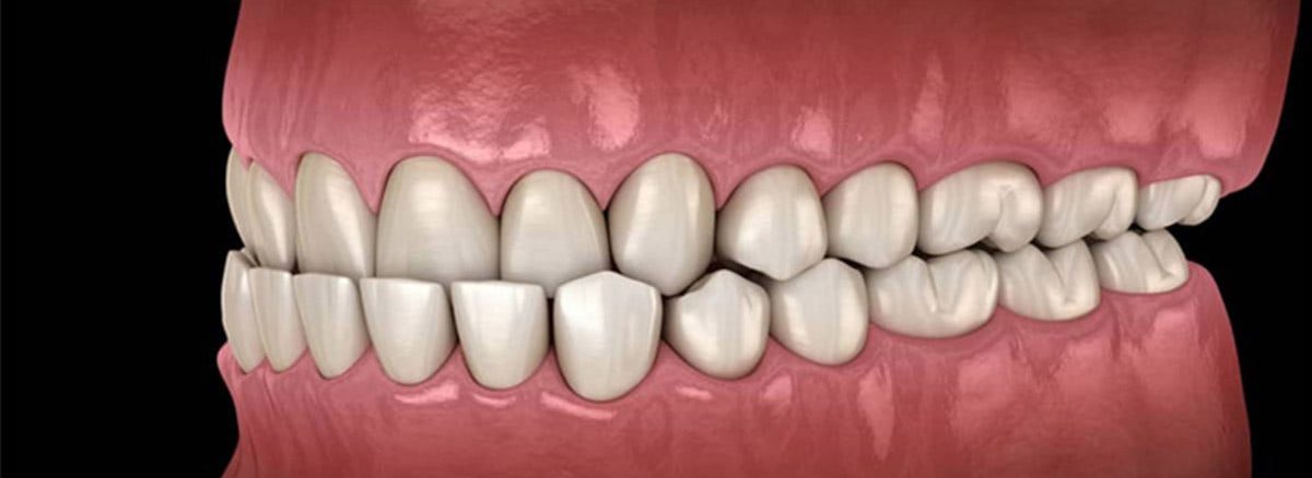 راهکار درمانی کراس بایت