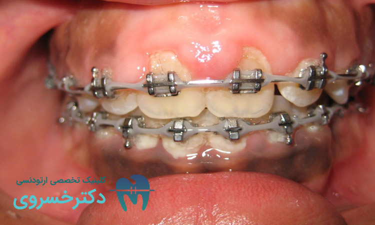 علل تحلیل لثه در دوران ارتودنسی