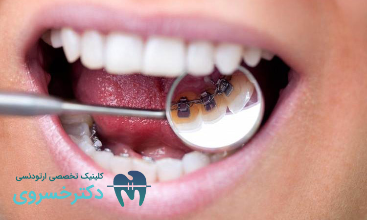 مراحل اجرای ارتودنسی برای درمان اوپن بایت