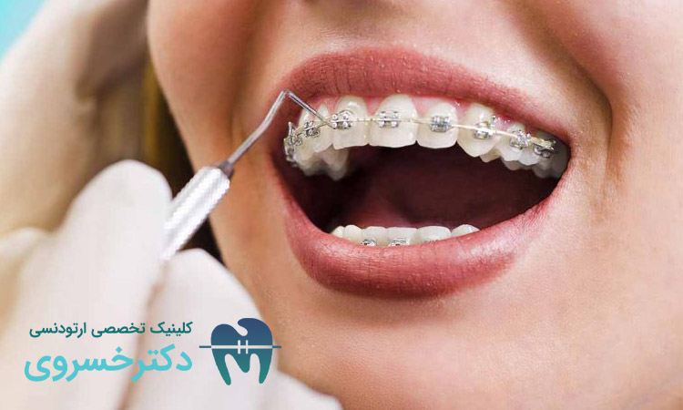 دلایل تحلیل لثه بعد از ارتودنسی