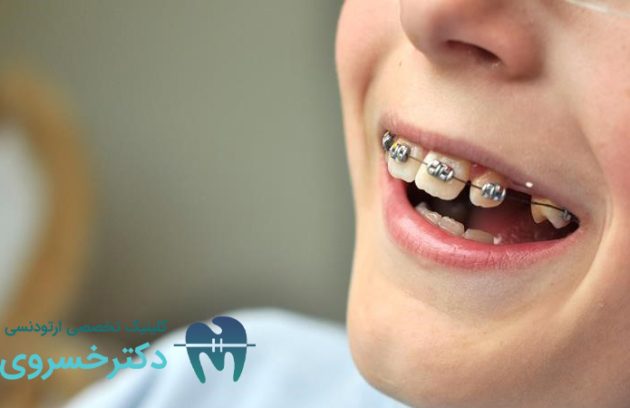 ارتودنسی دو مرحله‌ای