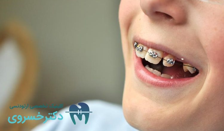 ارتودنسی دو مرحله‌ای