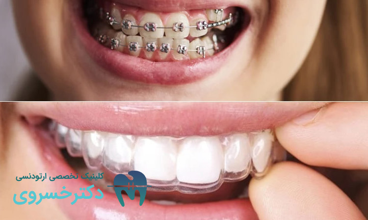 انتخاب دادن به بیمار ارتودنسی برای کشیدن دندان