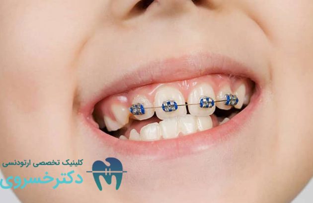 اهمیت ارتودنسی دندان کودکان