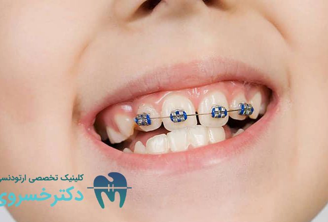 اهمیت ارتودنسی دندان کودکان