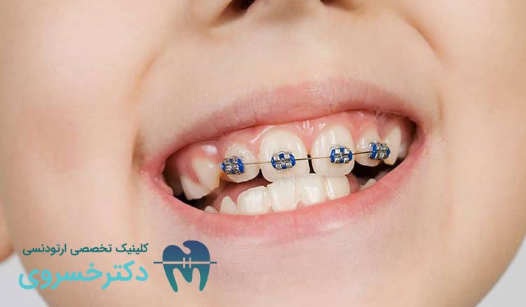 اهمیت ارتودنسی دندان کودکان