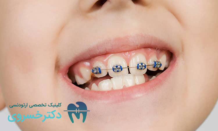 اهمیت ارتودنسی دندان کودکان