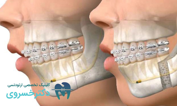 اهمیت کشیدن دندان در ارتودنسی