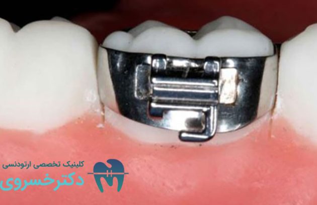 باندینگ ارتودنسی