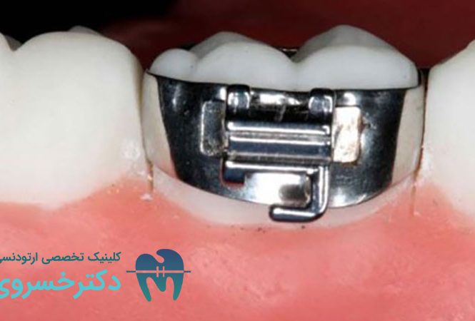 باندینگ ارتودنسی