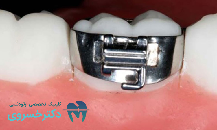 باندینگ ارتودنسی