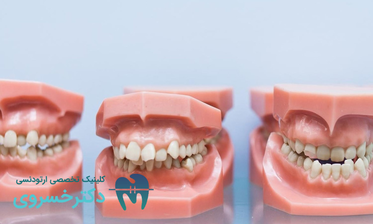 تاثیر انواع مال اکلوژن بر سلامت دندان