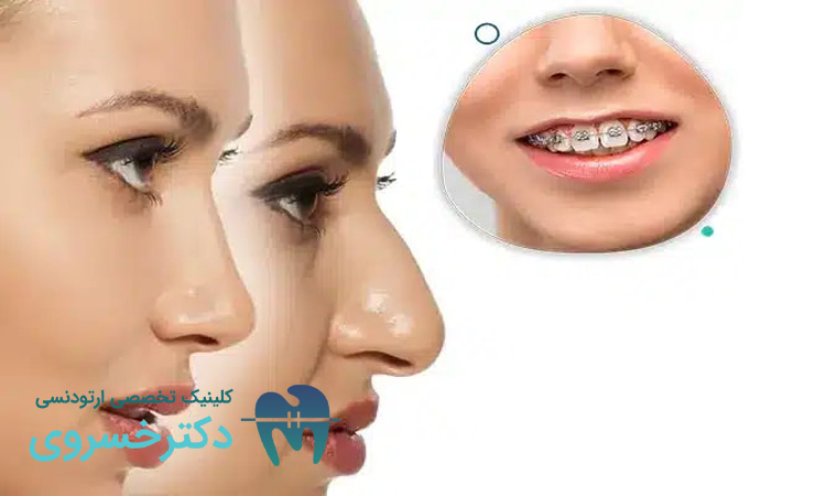 تأثیرات جراحی بینی بر برنامههای ارتودنسی