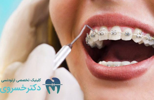 جرم گیری دندان در طول درمان ارتودنسی