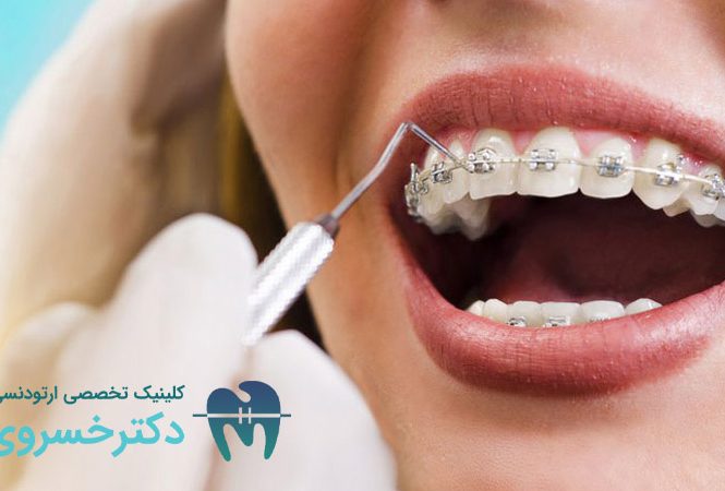 جرم‌ گیری دندان در طول درمان ارتودنسی