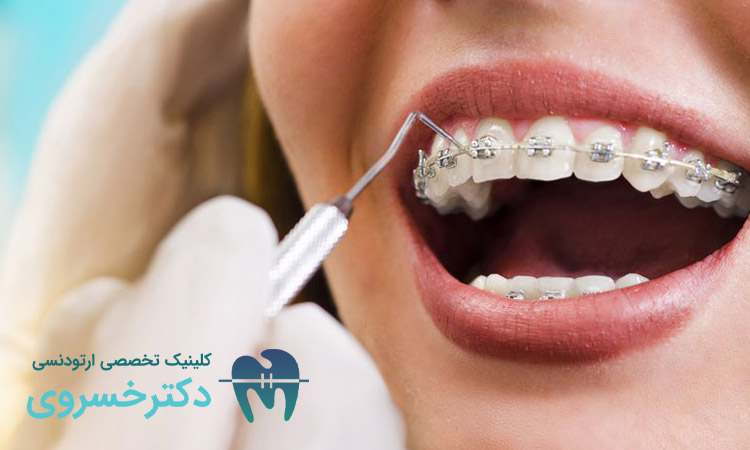 جرم‌ گیری دندان در طول درمان ارتودنسی