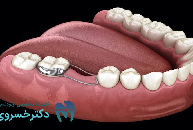 دلایل کشیدن دندان برای ارتودنسی