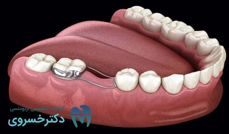 دلایل کشیدن دندان برای ارتودنسی