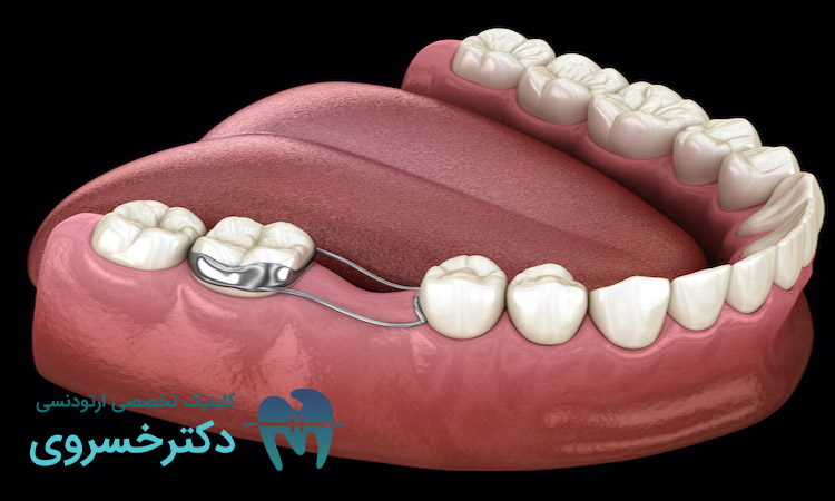 دلایل کشیدن دندان برای ارتودنسی