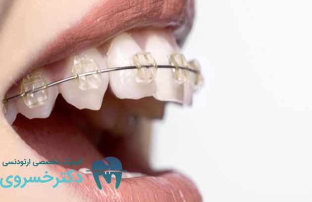 راهنمای نحوه تمیز کردن بریس ها به درست ترین روش