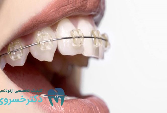 راهنمای نحوه تمیز کردن بریس‌ ها به درست ترین روش