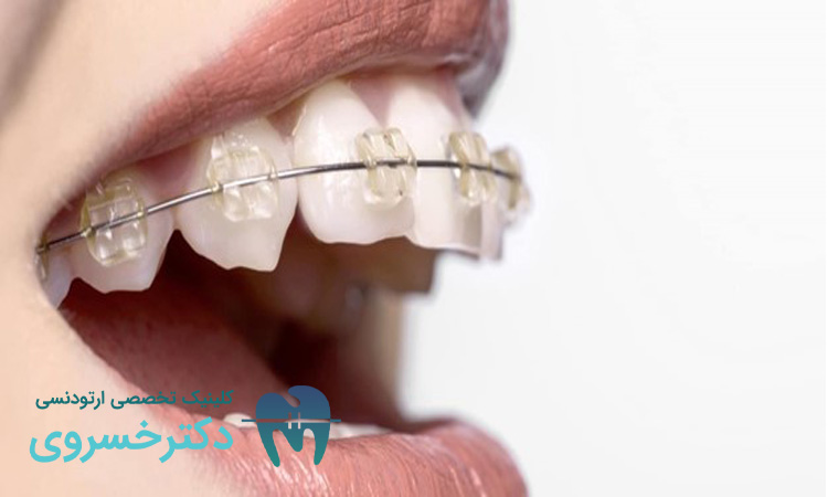 راهنمای نحوه تمیز کردن بریس‌ ها به درست ترین روش