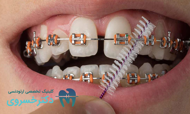 علل تغییرات رنگی دندان پس از ارتودنسی