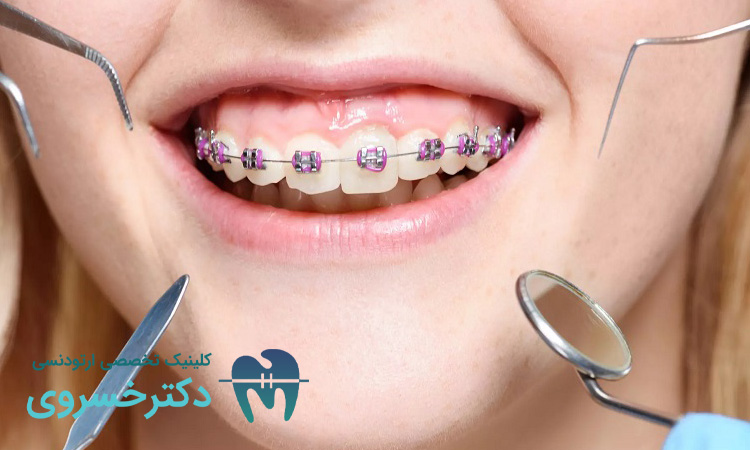 مقایسه ارتودنسی دو مرحله ای و دیگر روش ها