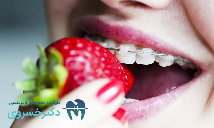 رژیم غذایی در تغییر رنگ دندان بعد از ارتودنسی