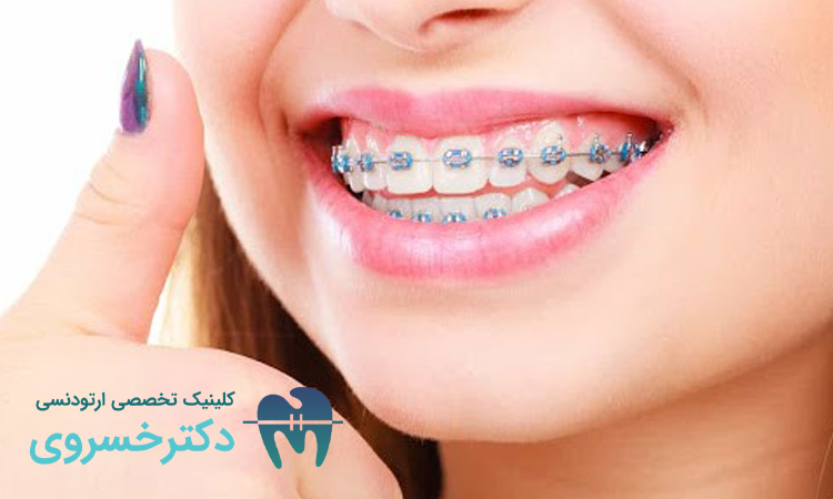 کشیدن دندان در ارتودنسی برای تعادل چهره