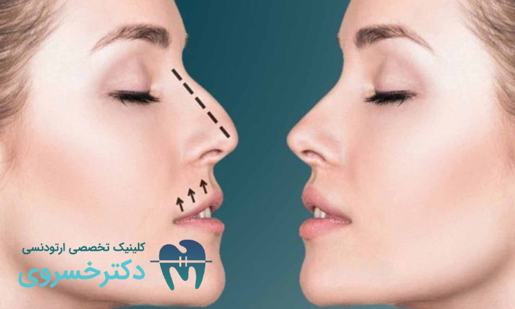نکات مهم برای ارتودنسی و جراحی بینی