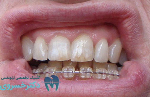 زرد شدن دندان بعد از ارتودنسی