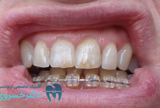 زرد شدن دندان بعد از ارتودنسی